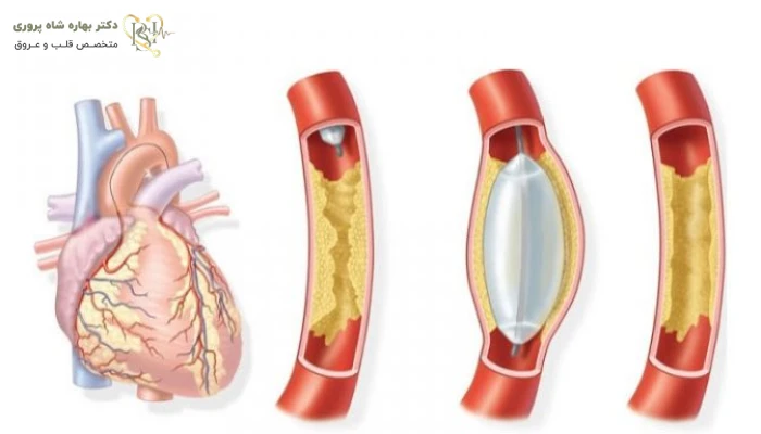 عوارض آنژیوگرافی قلب